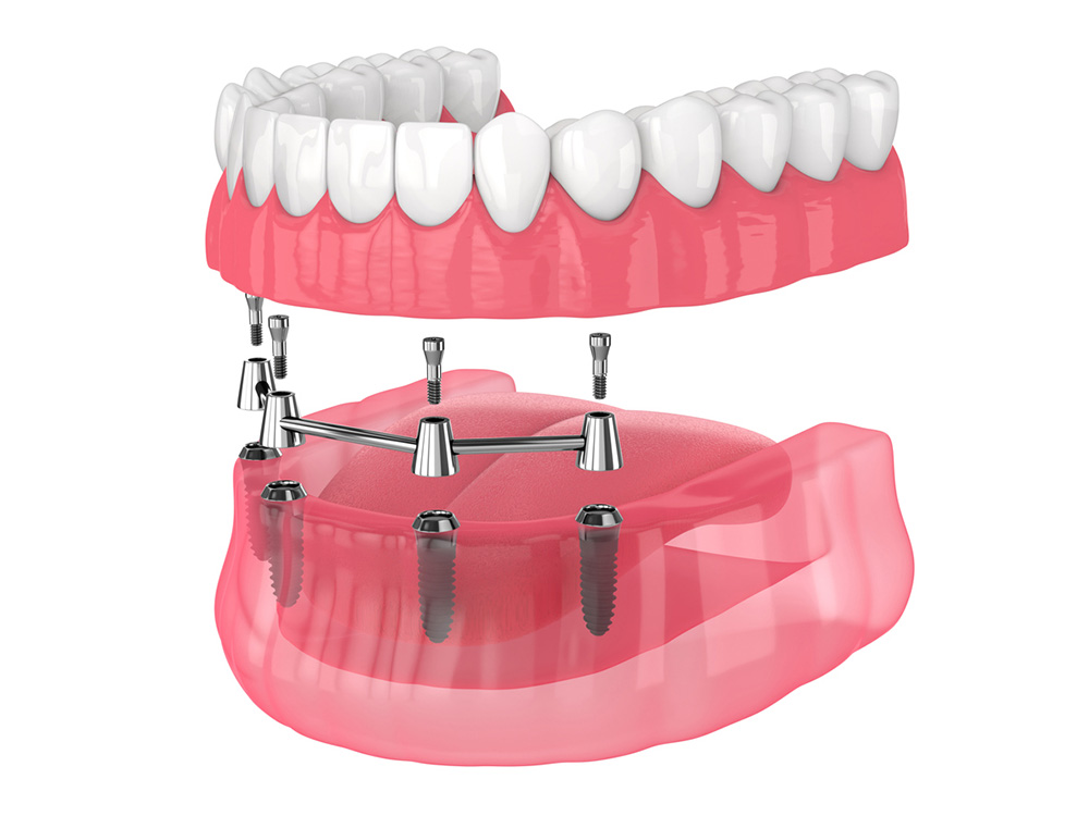 Full arch implant model, illustrative dental-care visual