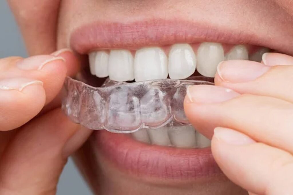 Illustrative image of Clear Aligners