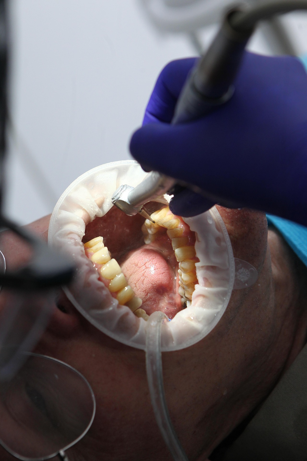 Tooth Extraction at Paradise Medical Dental Centre Karachi