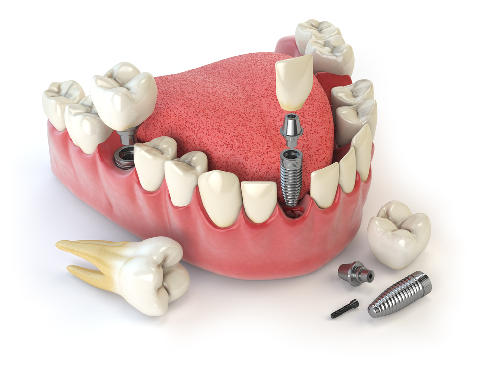 Illustrative image of Dental Implants