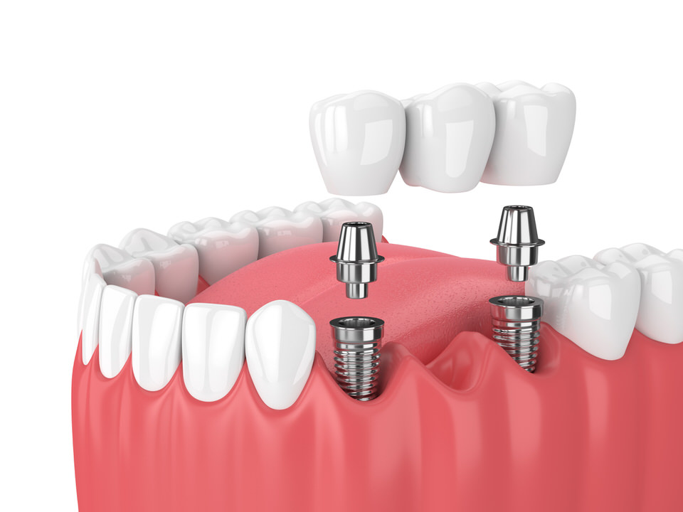 Illustrative image of Crowns & Bridges